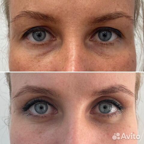 Верхняя блефаропластика